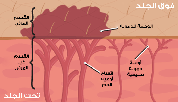An image showing a blood nevus and its components under the skin and above the skin