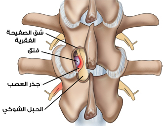 A picture of the spine and its shape when a herniated disc in one of the vertebrae