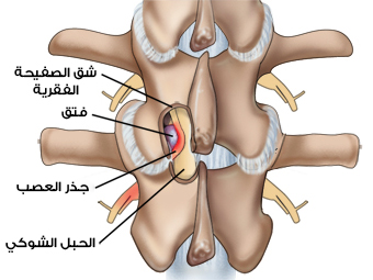 صورة للعمود الفقري وشكله عند اﻹصابة بالإنزلاق الغضروفي في إحدى الفقرات