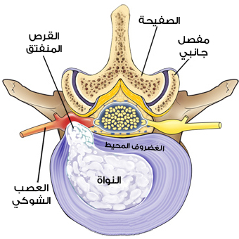 Slipped vertebral disc (disc) before microscopic disc surgery
