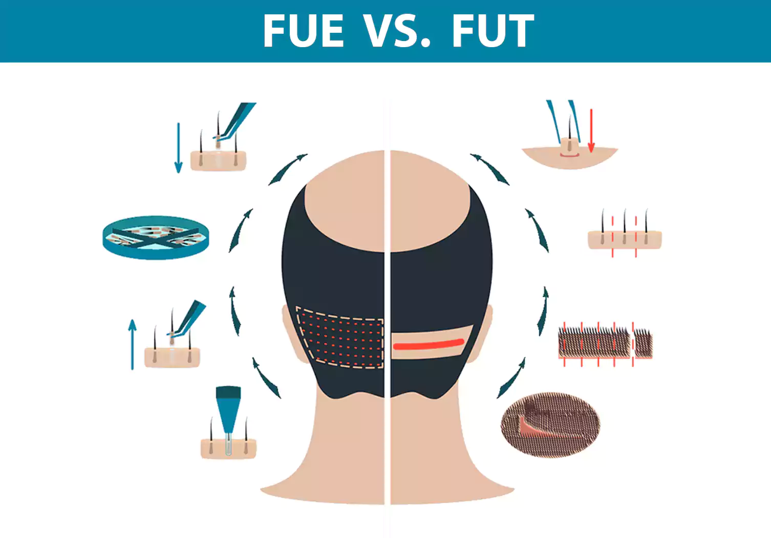 صورة توضح الفرق بين زراعة الشعر بالاقتطاف Fue وزراعة الشعر بزراعة حدة البصيلات Fut