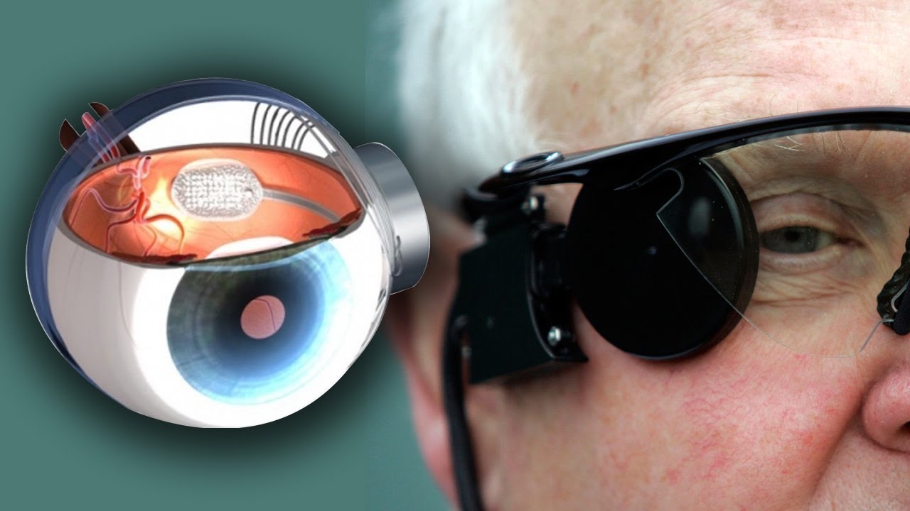 صورة توضح جهاز زراعة الشبكية الاصطناعية (زراعة العين البيوالكترونية)