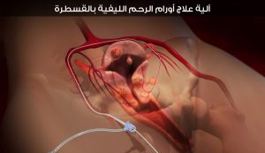 آلية علاج أورام الرحم الليفية بالقثطرة