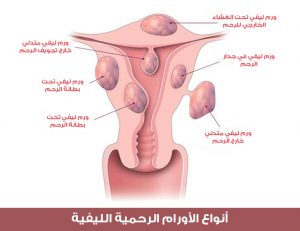 أنواع الأورام الرحمية الليفية