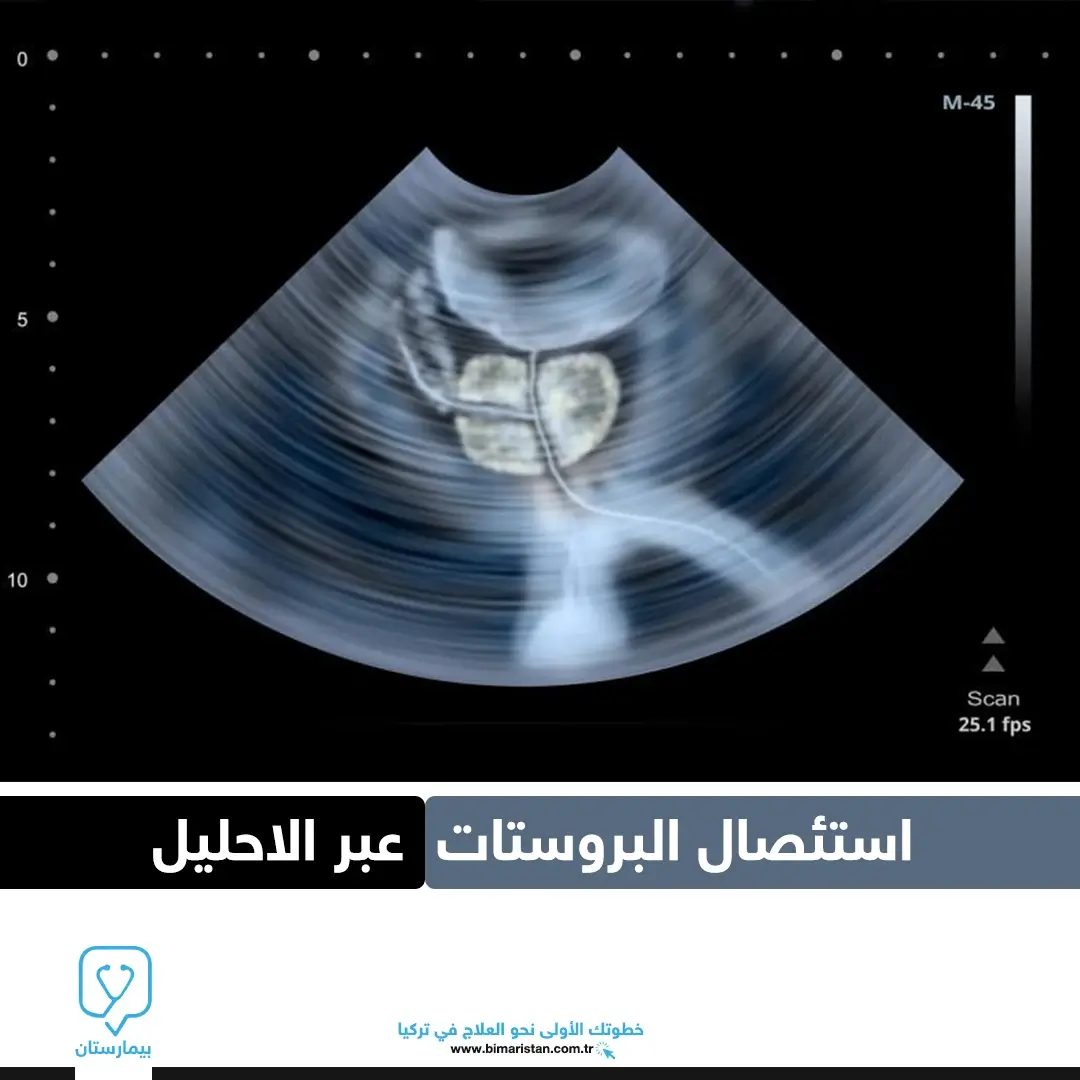 Transurethral resection of the prostate