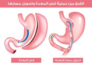 الفرق بين عملية قص المعدة وتحويل مسارها