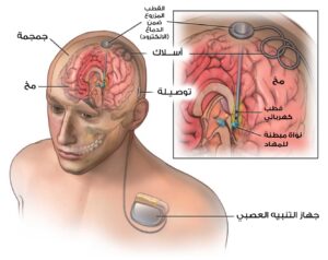 رسم توضيحي لتموضع جهاز التحفيز العميق للدماغ