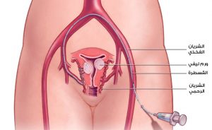 رسم توضيحي لعلاج أورام الرحم الليفية بالقثطرة