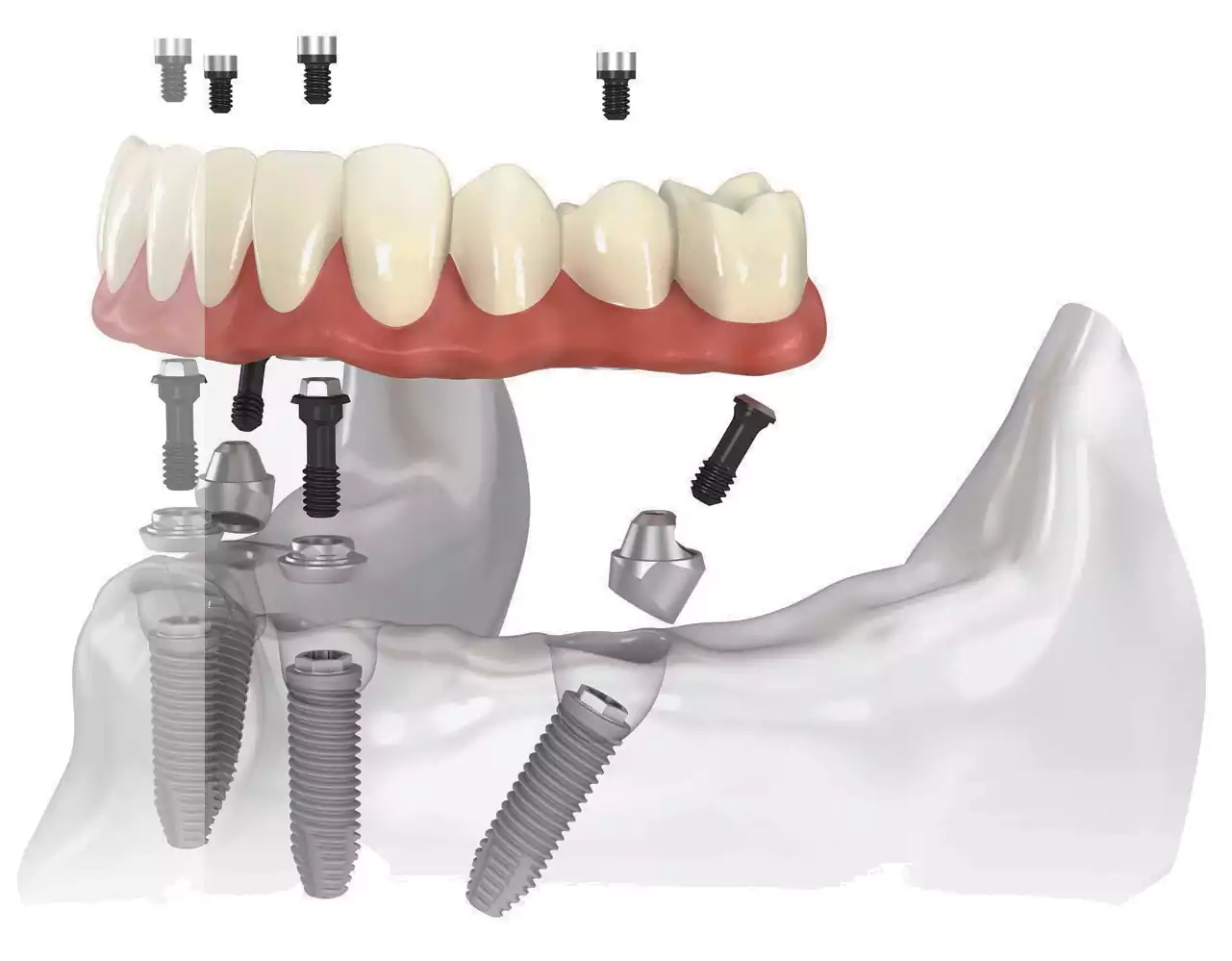 زراعة الأسنان بتقنية الكل على أربع للأسنان السفلية