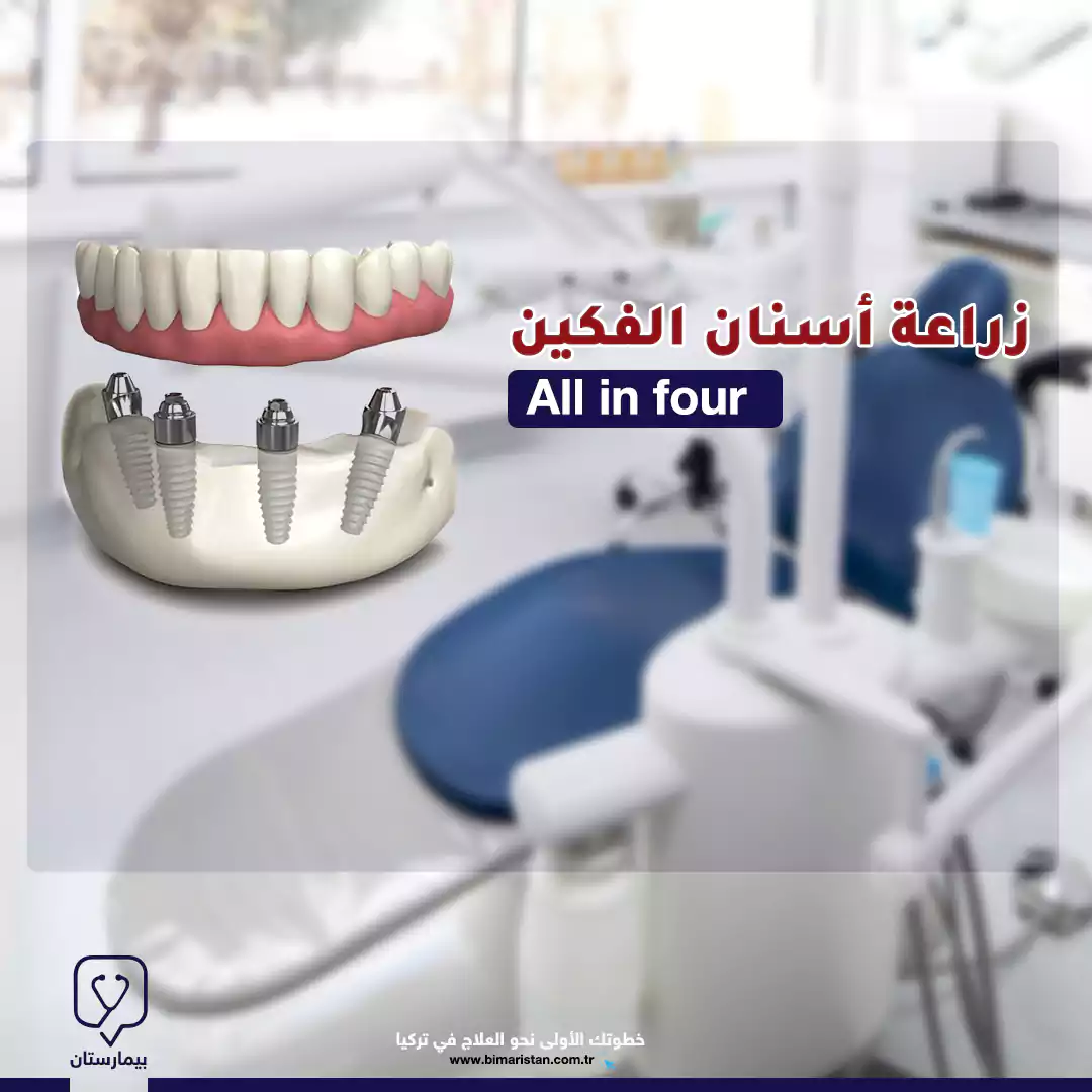 Dental implants with all-on-fours technology