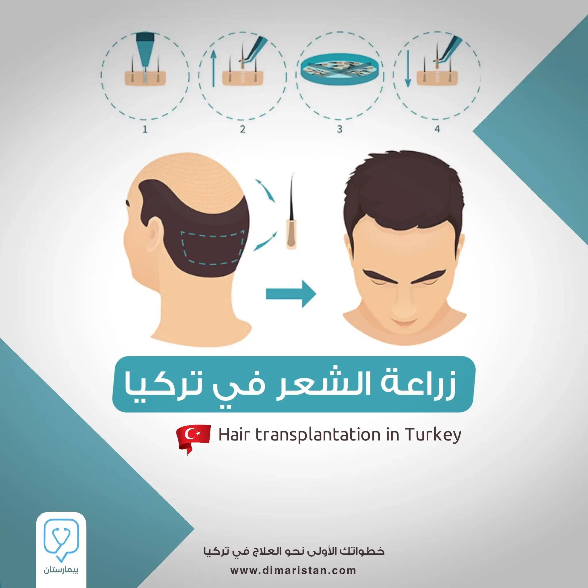 Hair transplantation in Turkey