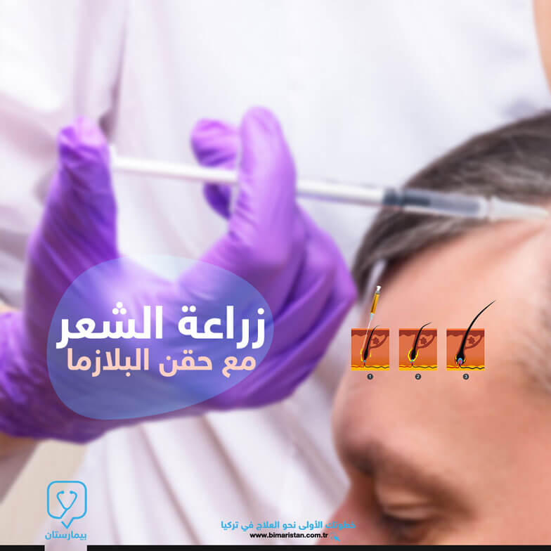 Hair transplantation with plasma injection
