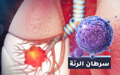 أعراض سرطان الرئة والتشخيص والعلاج في تركيا