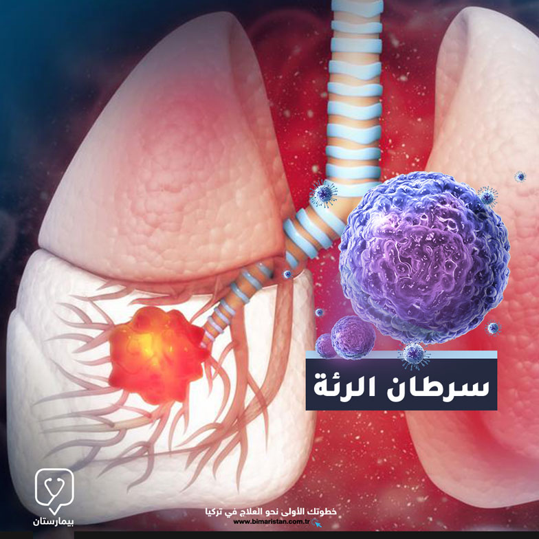 Türkiye'de akciğer kanseri tedavisi