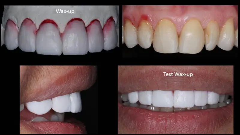 A picture showing the rigidity of the color of the teeth and the loss of their luster due to the poor quality of the preparation of the crown