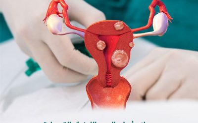 Catheter treatment of uterine fibroids
