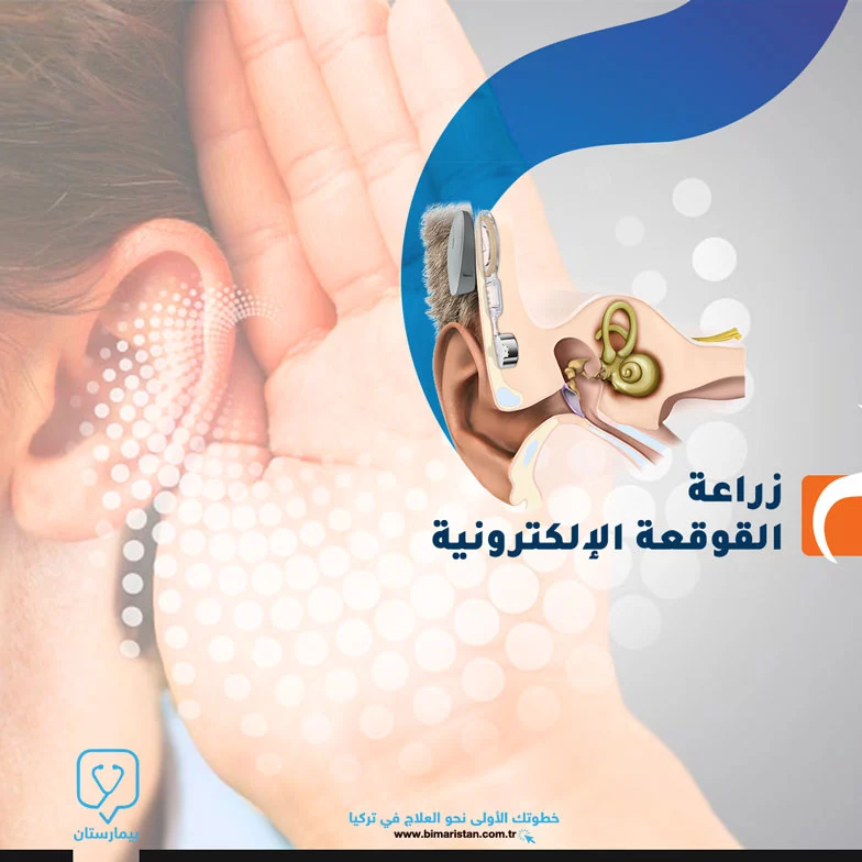 Cochlear implant process