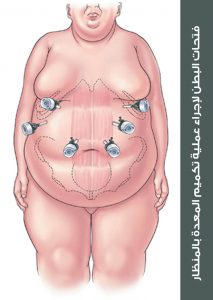 فتحات البطن لإجراء عملية تكميم المعدة بالمنظار