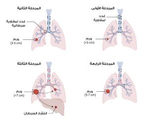 مراحل سرطان الرئة