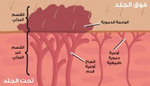 مقطع تشريحي للوحمة الوعائية