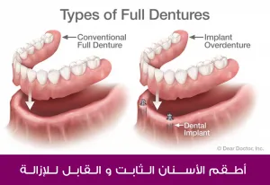 أطقم الأسنان الثابت والقابل للإزالة