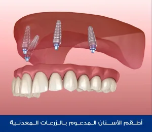 أطقم الأسنان المدعوم بالزرعات المعدنية