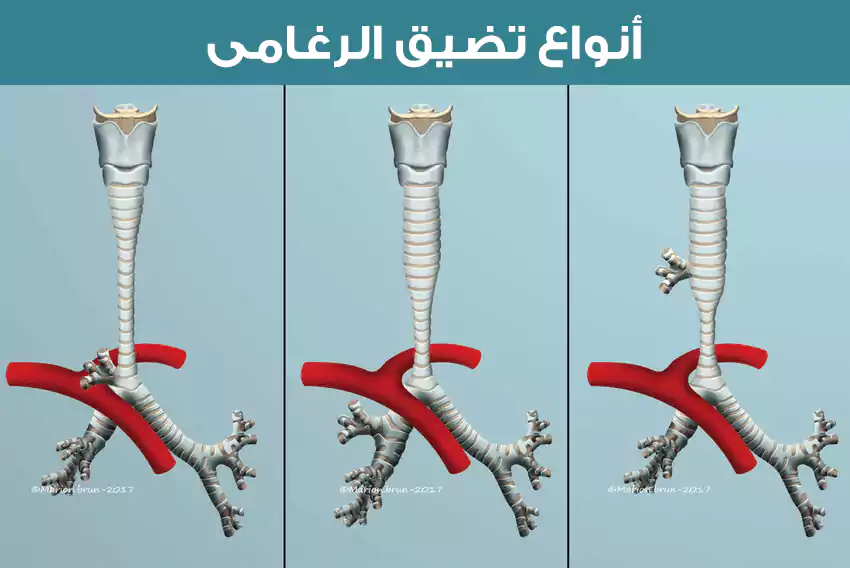 بعض الأنواع التي لايمكن علاج تضيق الرغامى فيها إلا جراحياً