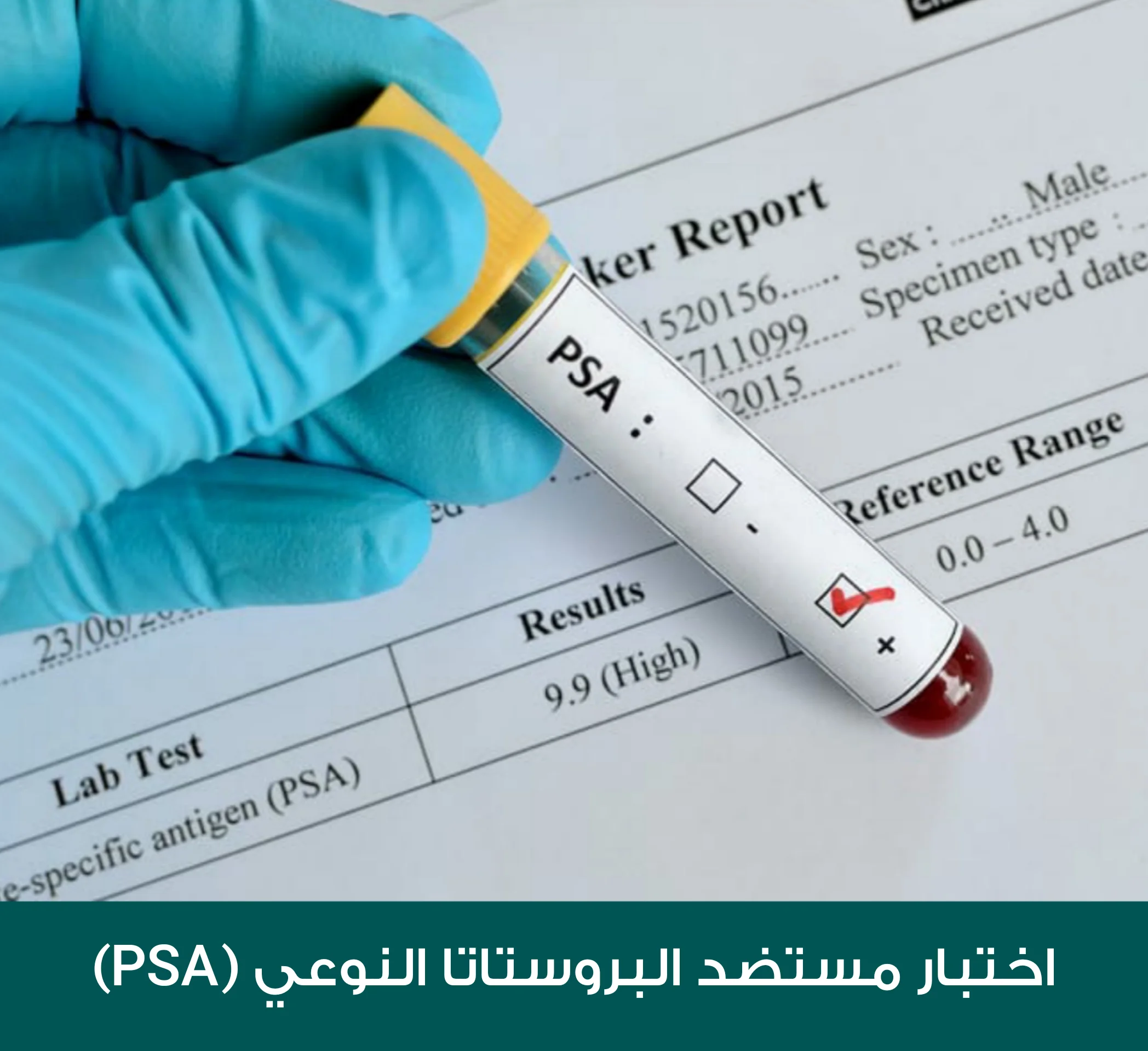 Prostate-specific antigen (PSA) test result