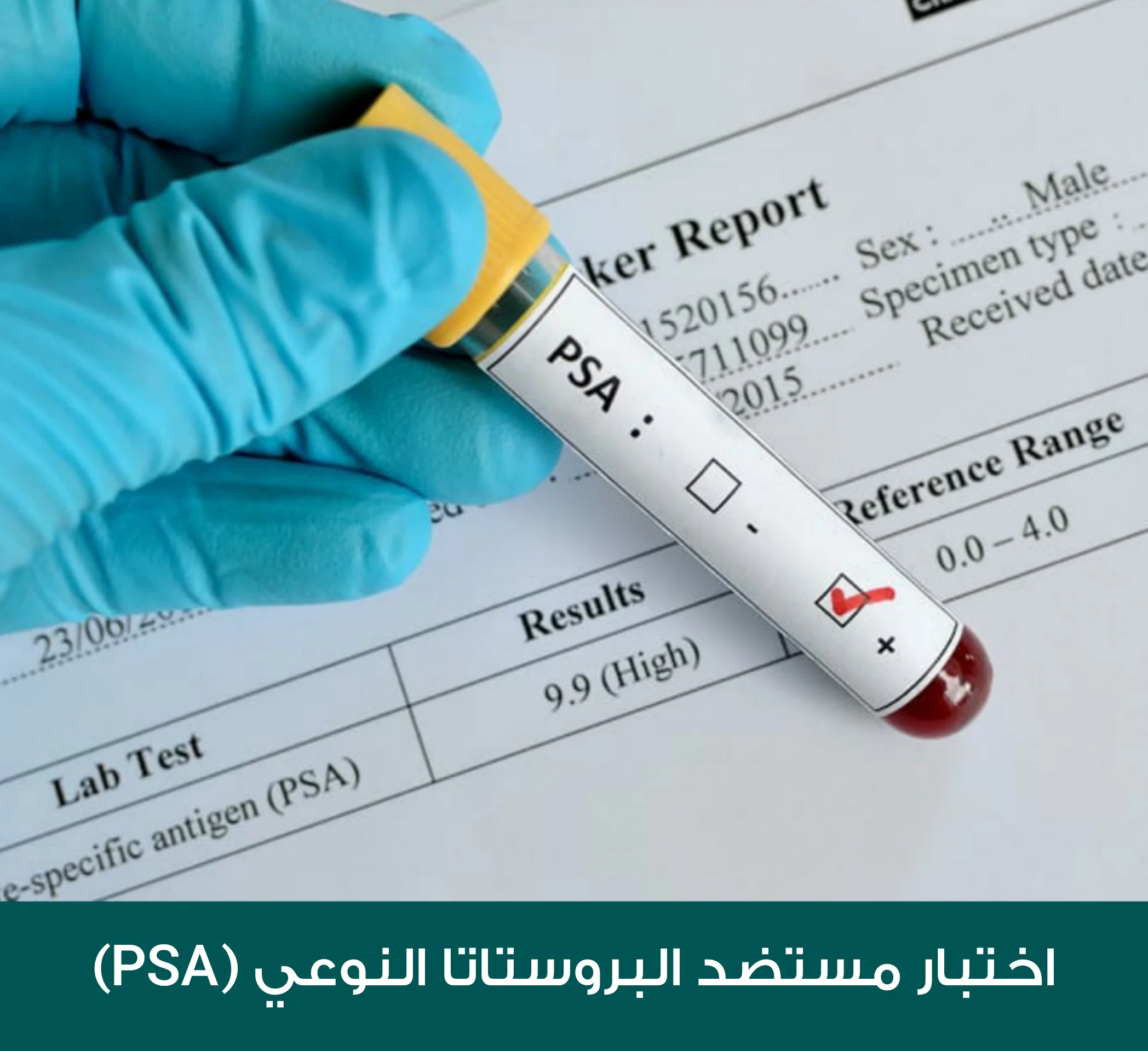 نتيجة اختبار مستضد البروستاتا النوعي (Psa)