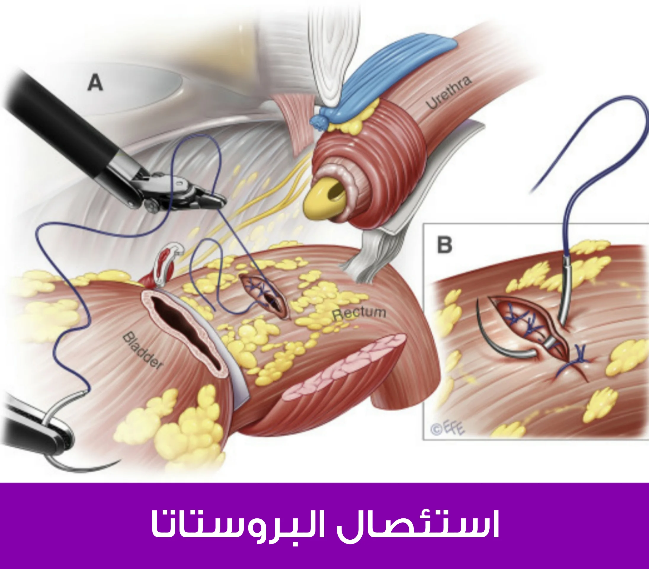 استئصال البروستاتا بواسطة الروبوت في تركيا