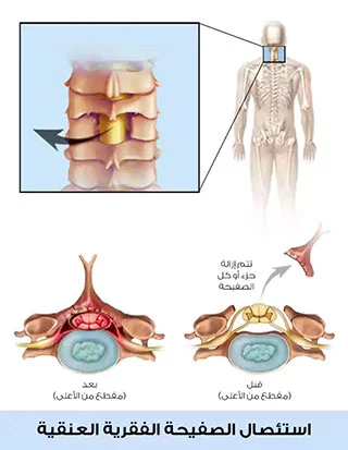 Resection of a section of the vertebral plate, which is one of the surgical methods for managing spinal stenosis in Turkey