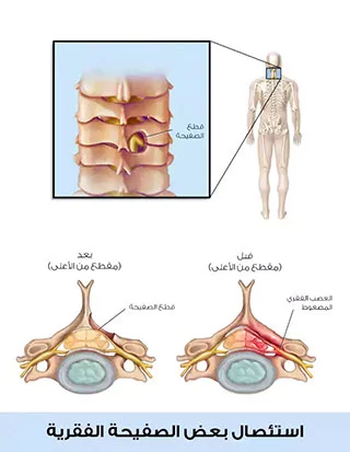Intervertebral foramenotomy, a type of spinal stenosis surgery in Turkey
