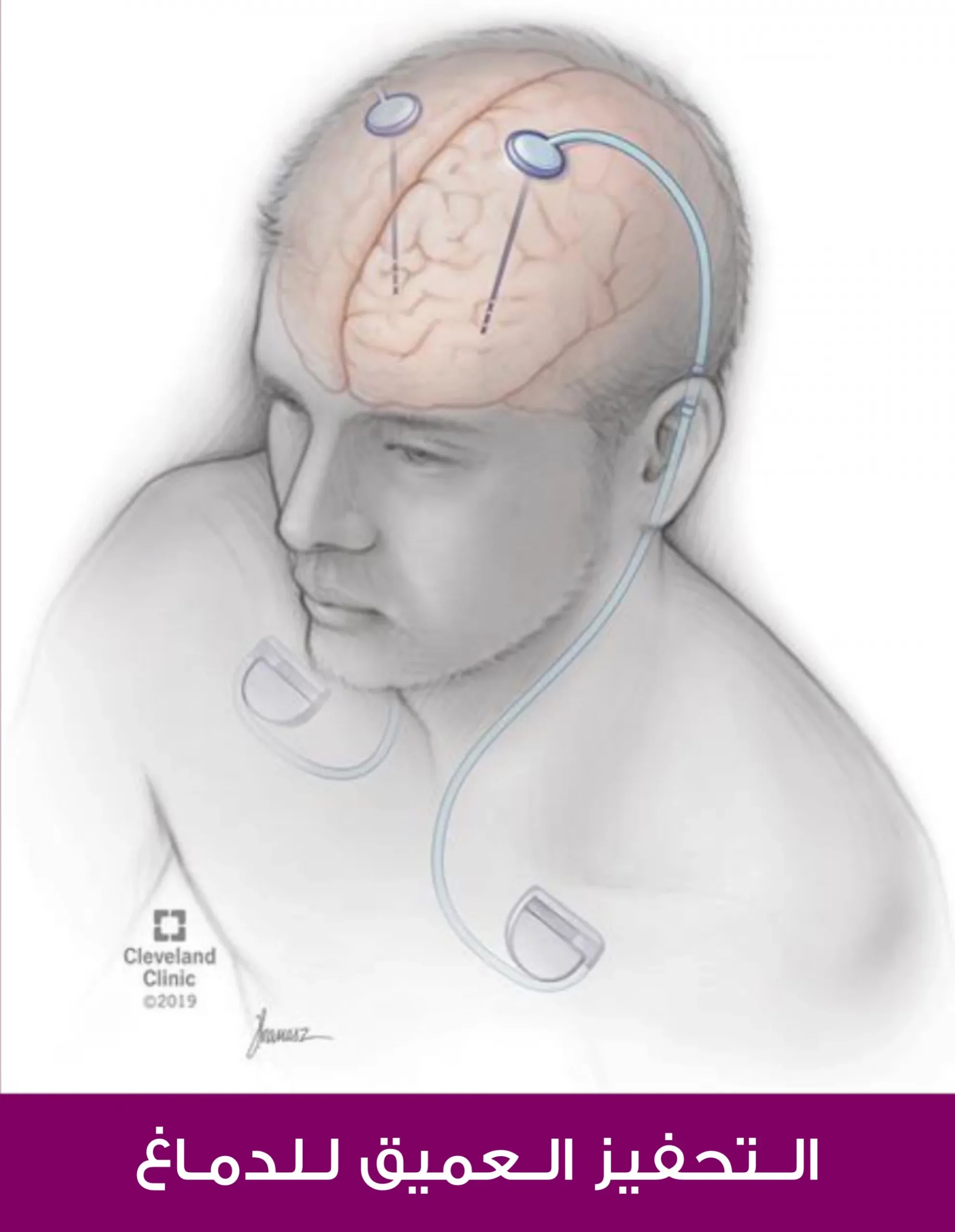 Deep brain stimulation, which is used to treat epilepsy in Turkey