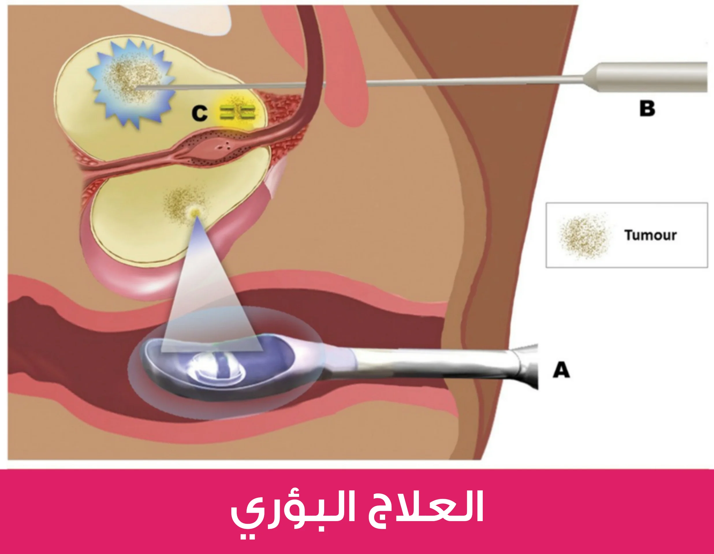 العلاج بالأشعة فوق الصوتية عالية الشدة وهو من طرق علاج سرطان البروستاتا