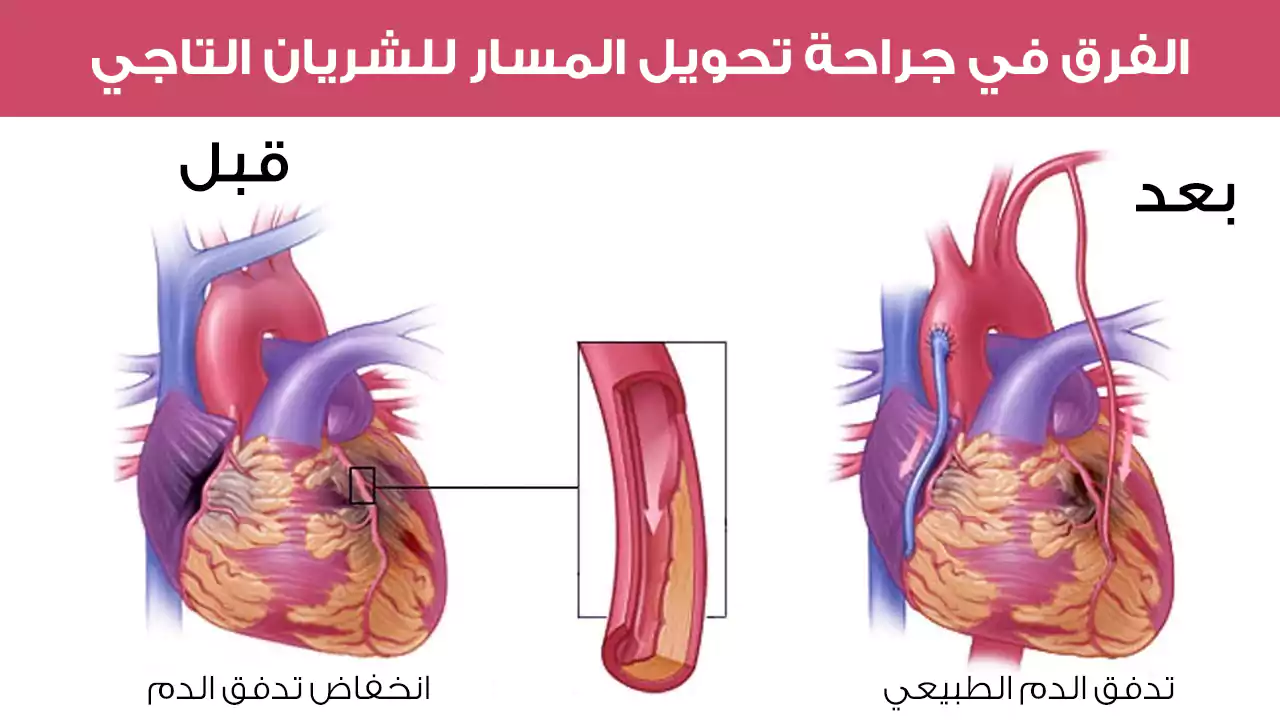 The difference in coronary bypass surgery