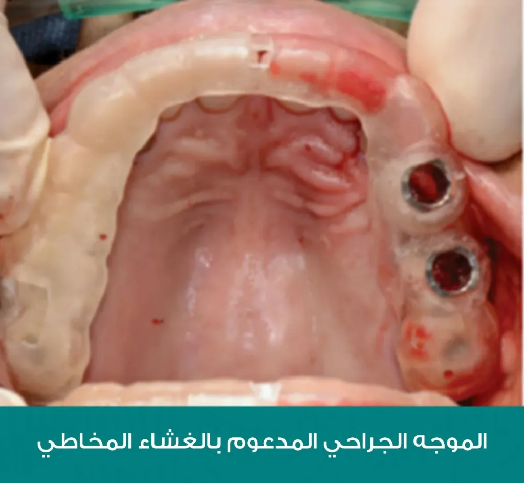 زراعة الأسنان بدون جراحة باستخدام الدليل الجراحي