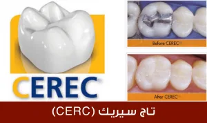 تلبيس تاج الأسنان ثلاثي الأبعاد في تركيا
