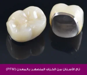 Dental crown made of porcelain fused to metal