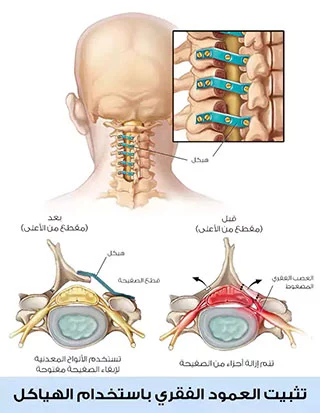 Fixation of the spine using plates and structures