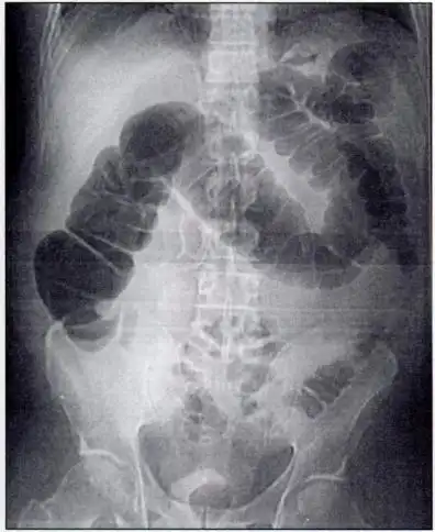 Picture of a CT colonography (virtual colonoscopy)