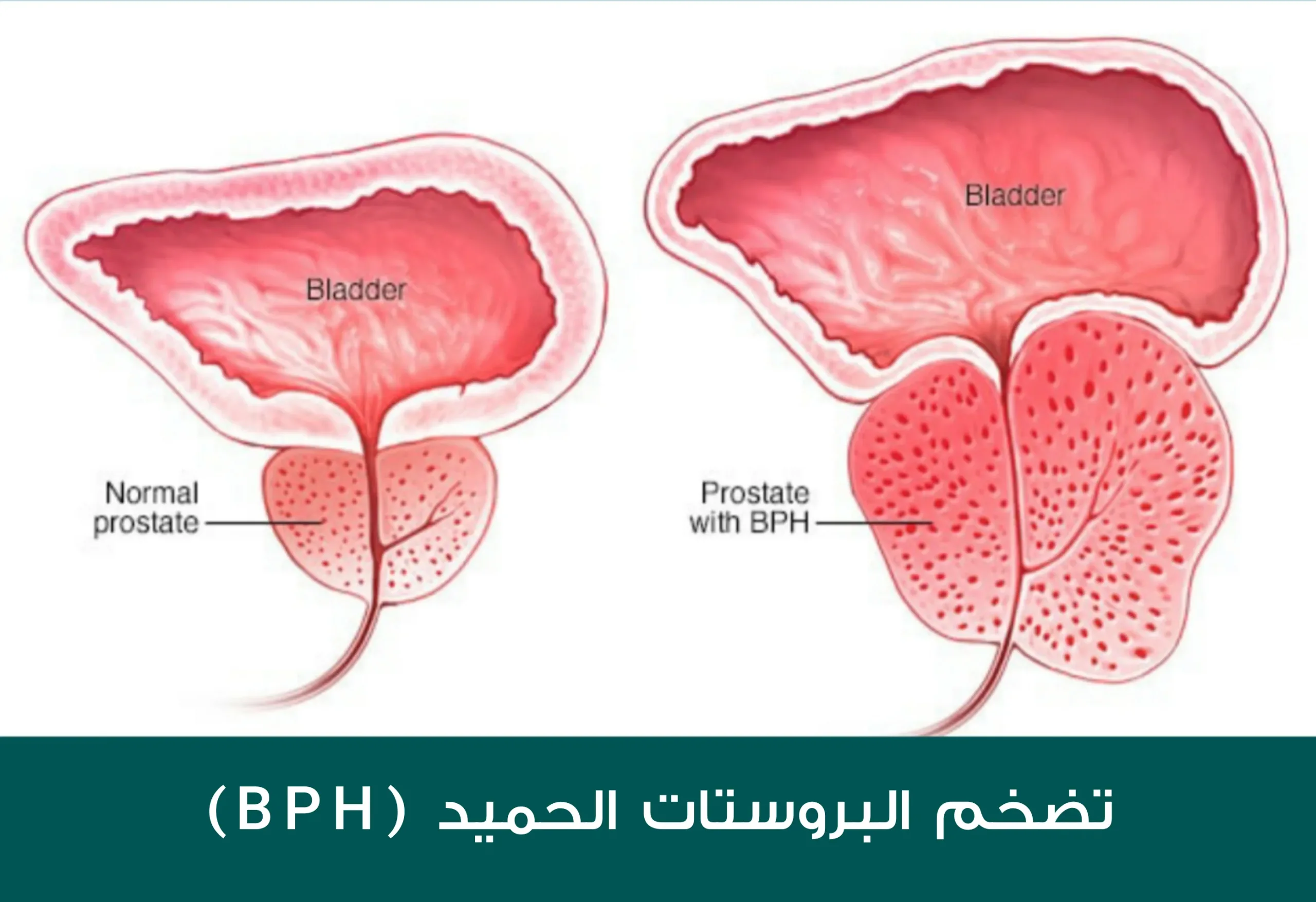 ضخامة كبيرة للبروستات مقارنةً مع الحالة الطبيعية والتي تظهر على الجانب المقابل من الصورة