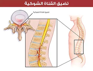 spinal stenoz