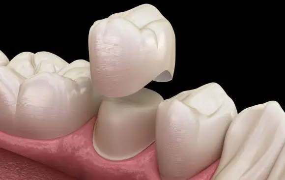 3D diş kronları