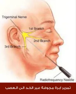 Passing a hollow needle through the cheek into the nerve
