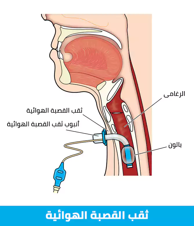 ثقب القصبة الهوائية حيث تعتبر من الطرق التقليدية من جراحة القصبة الهوائية