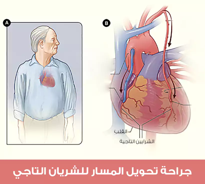 The normal location of the heart and coronary arteries