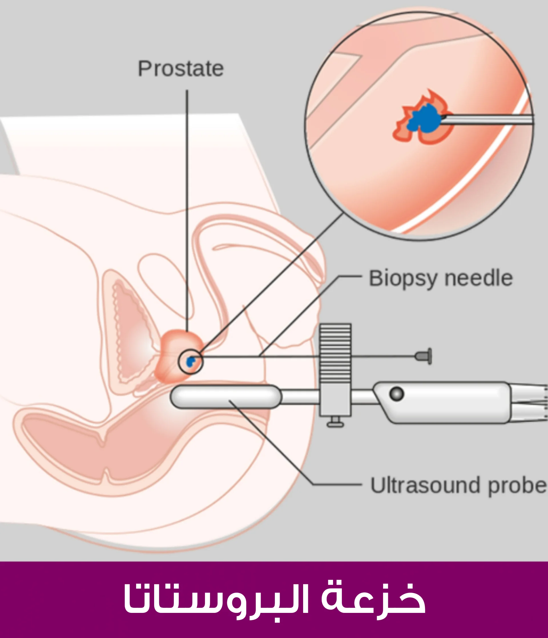 How to take a biopsy of the prostate