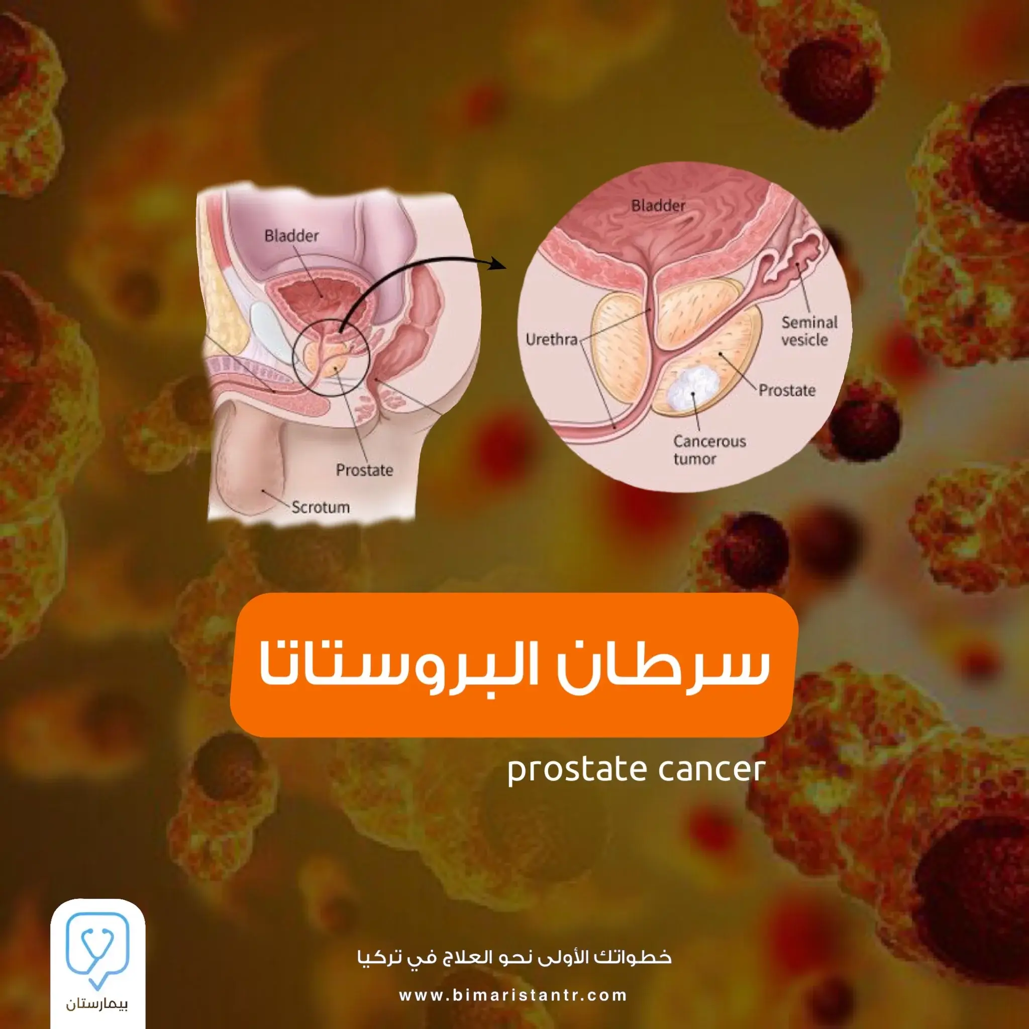 All you need to know about prostate cancer