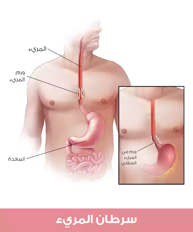 Esophageal cancer is localized in relation to the rest of the body