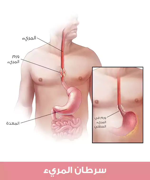 توضع سرطان المريء بالنسبة لبقية أجزاء الجسم